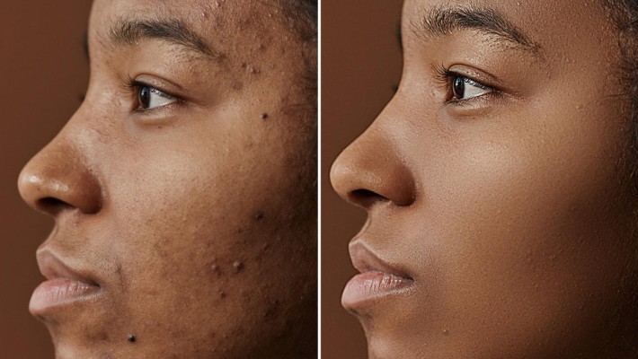 آموزش روتوش پوست صورت در فتوشاپ